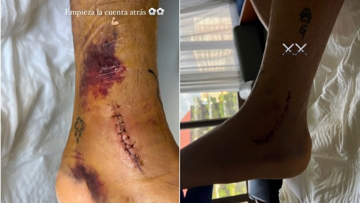 Las fotos del tobillo de Juanmi Jiménez tras la intervención en los ligamentos. (Instagram Juanmi)