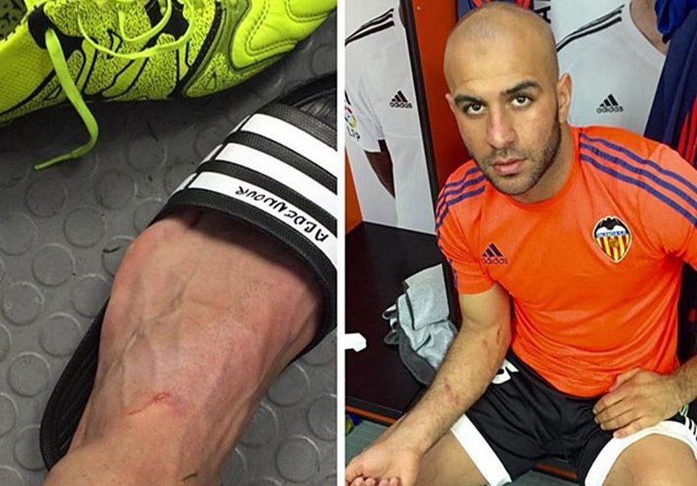 Abdennour, jugador del Valencia, muestra las heridas provocadas por Luis Suárez. Instagram