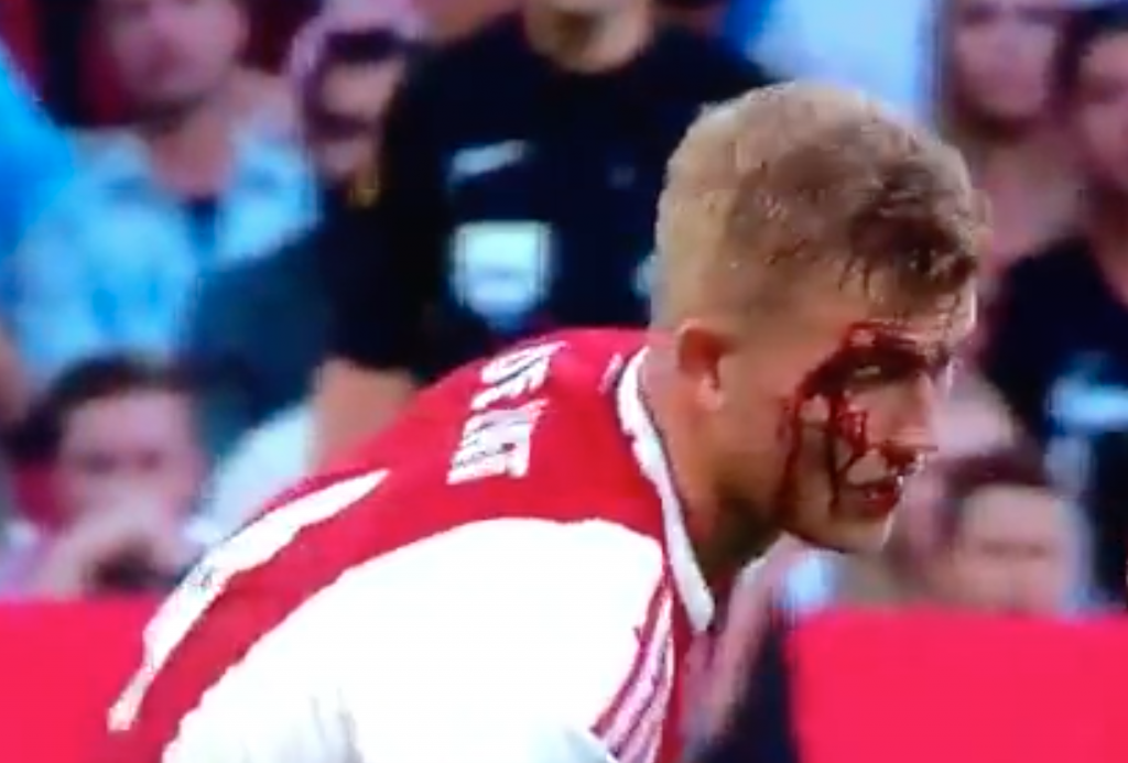 Así le quedó la cara a De Ligt tras un choque de cabezas