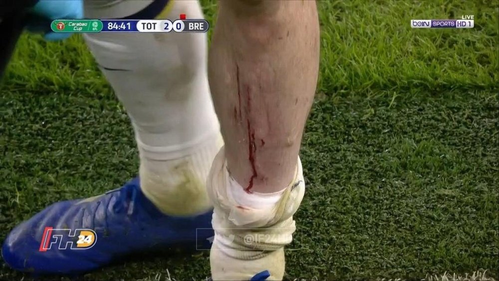 Hojbjerg's leg after nasty challenge. Screenshot/DAZN