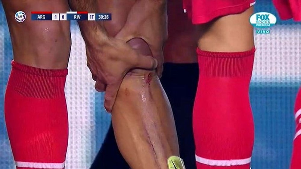 Así quedó la pierna de Silva después de la dura entrada de De la Cruz. Captura/FOXSports