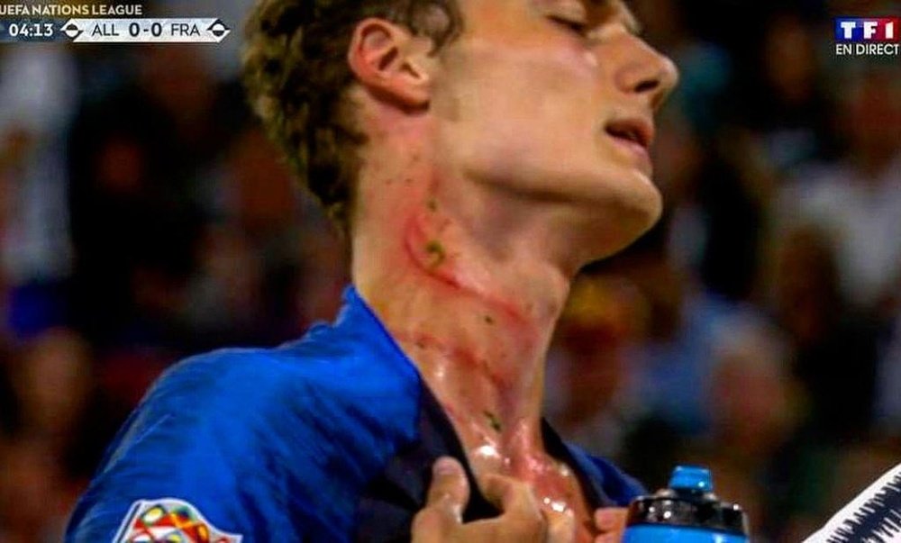 Benjamin Pavard was left with nasty injuries after Antonio Rudiger stamped on him. Captura/TF1