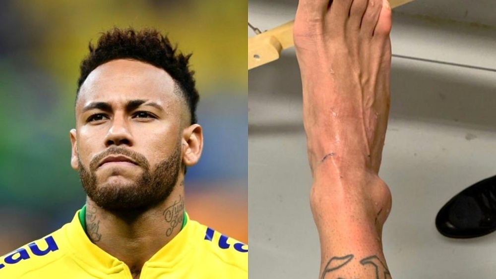 neymar mostra la caviglia dopo l infortunio