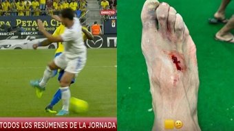 Akapo acabó con el pie sangrando por un plantillazo de Hazard. Twitter/GolTV/carlosakapo