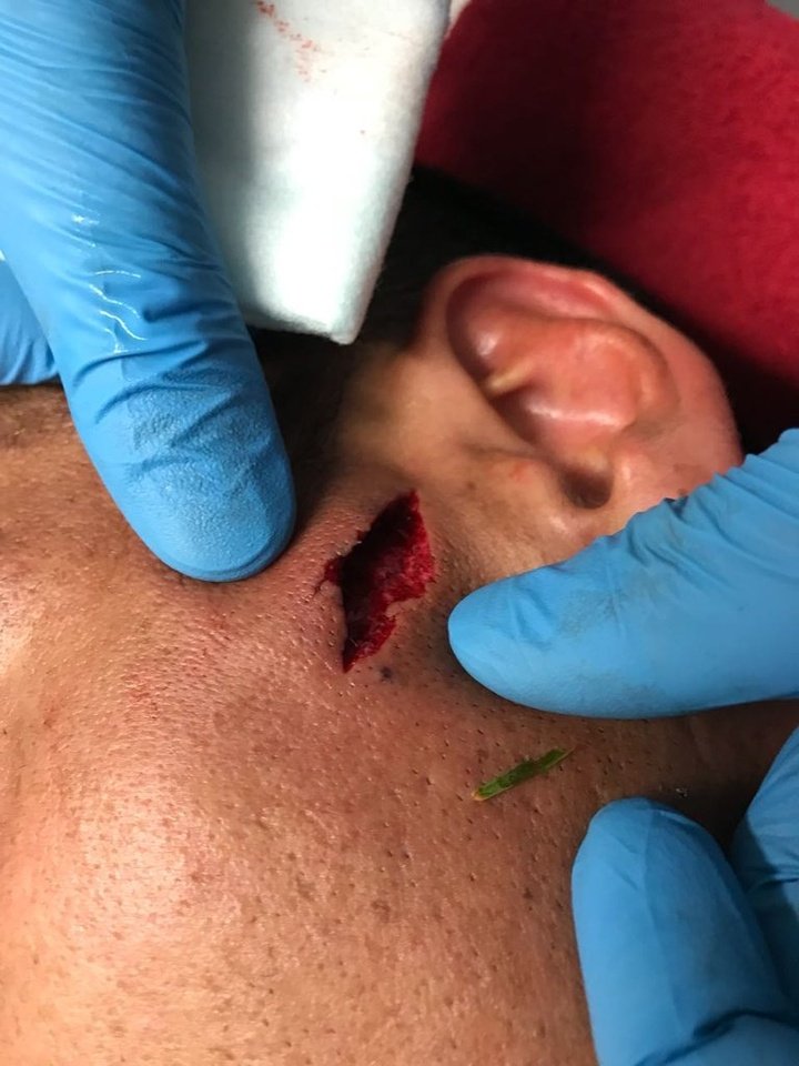 13 points de suture pour Fabián Monzón à cause d'une grosse coupure au visage