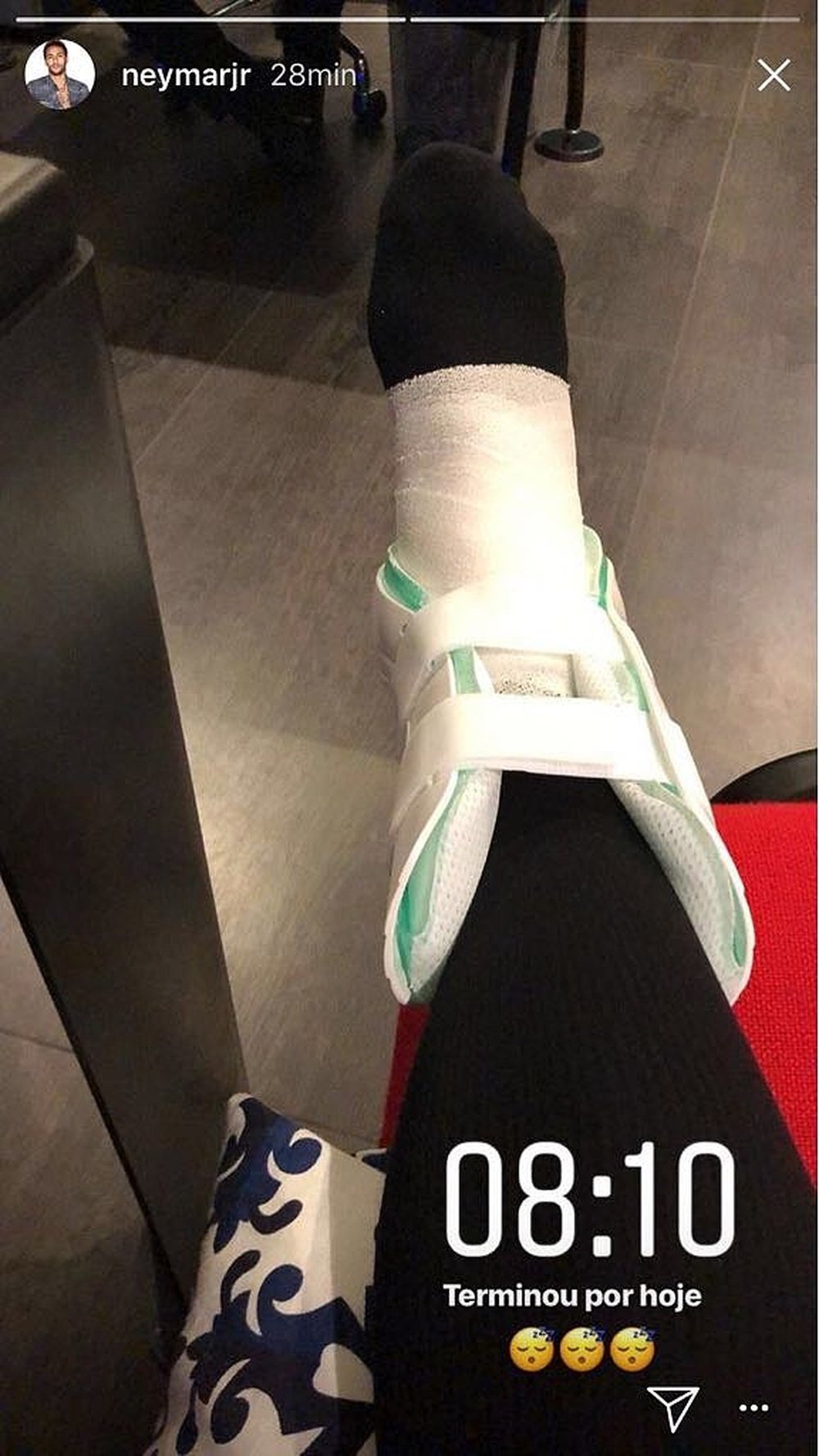 Neymar showed the severity of his injury with this photo. Instagram/NeymarJr