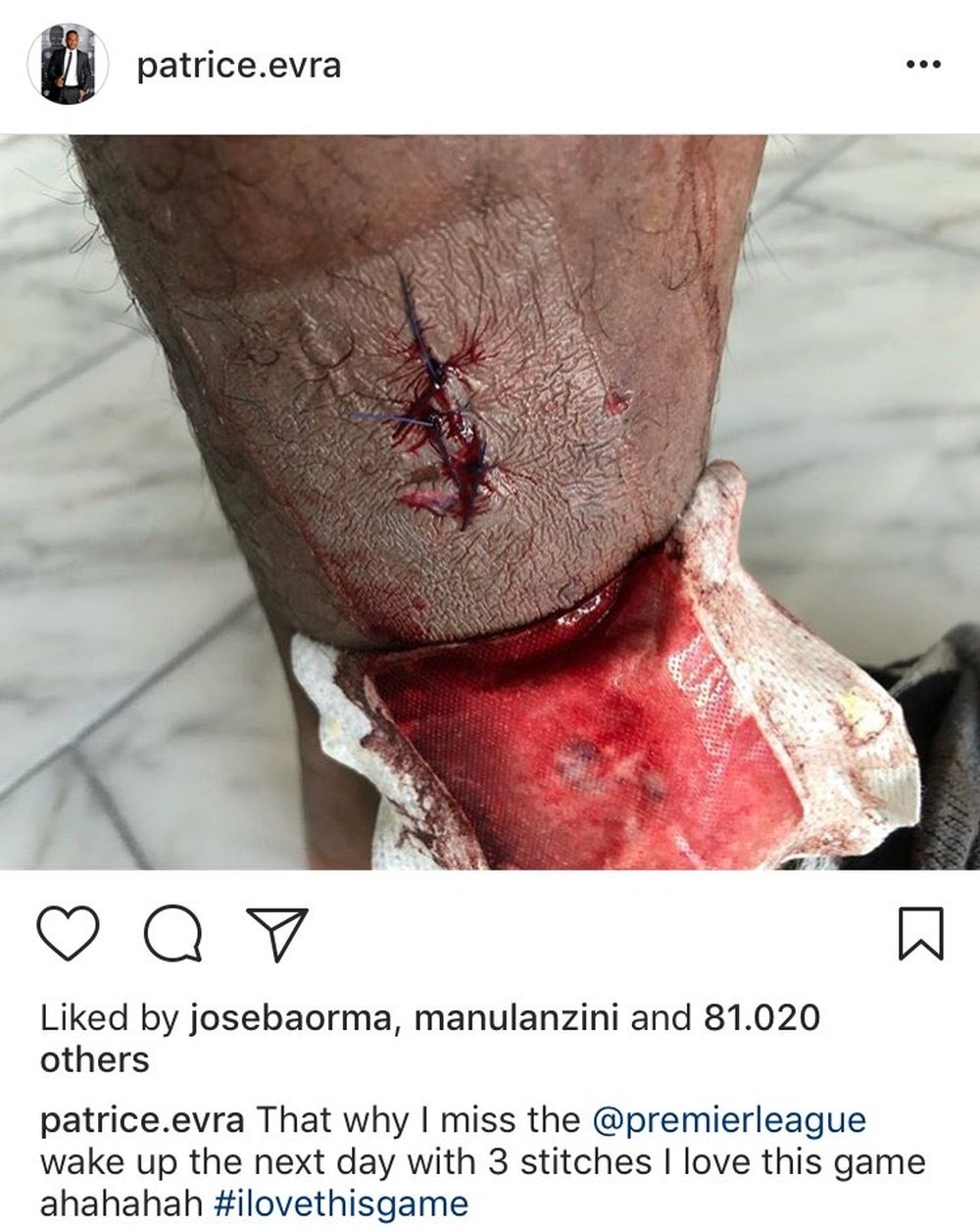 The Frenchman showed off his wound on social media. Instagram/Evra