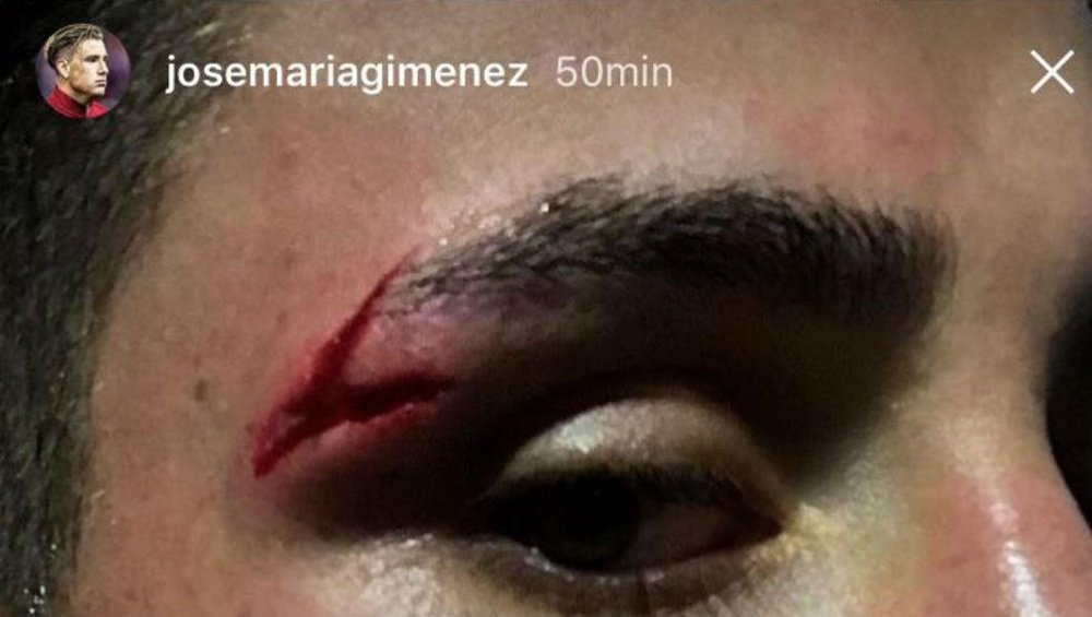 Giménez acabó con esta brecha en la ceja. Instagram/JoseMaríaGiménez