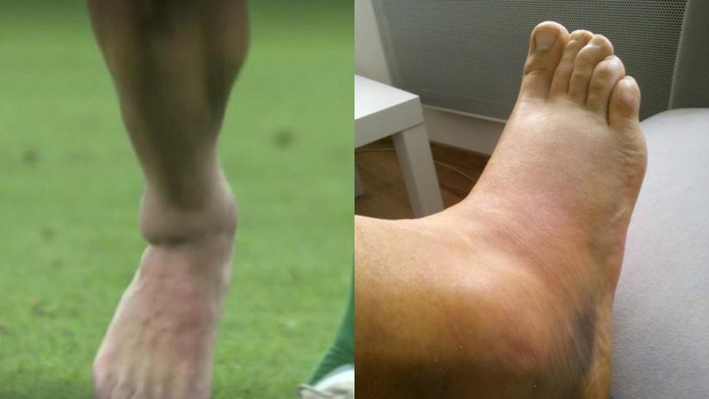 Entorse De La Cheville Droite Et 6 Semaines D Indisponibilite Pour Sergi Palencia