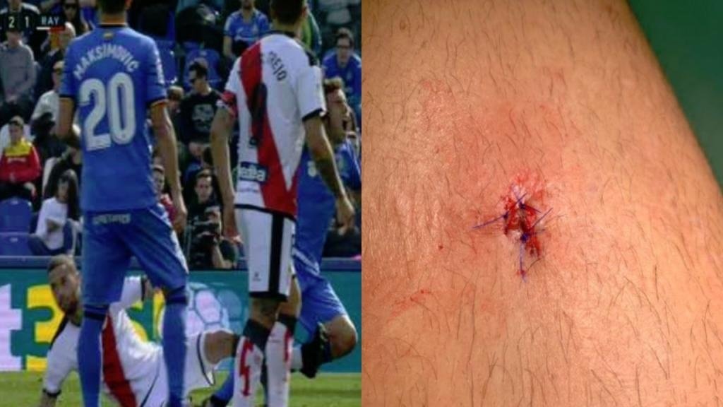 Mario Suárez se quejó en Twitter: tres puntos de sutura... ¡y una amarilla!