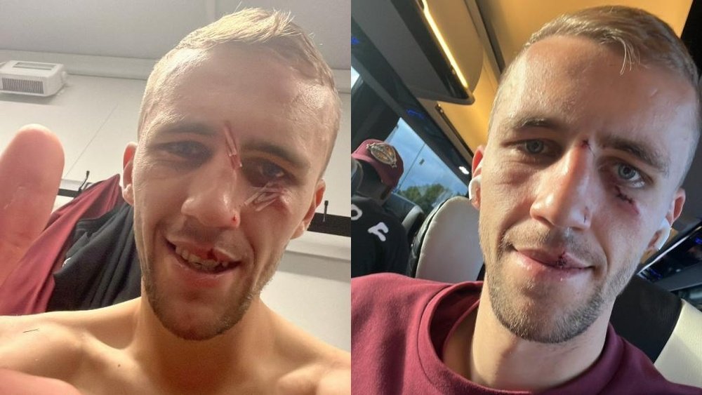 Soucek sigue coleccionando heridas de guerra en su cara. Twitter/TomasSoucek