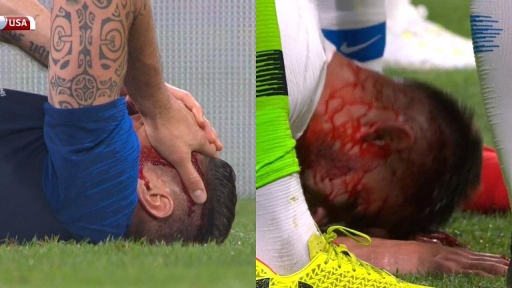 Giroud and Miazga suffered serious head injuries. BeSoccer