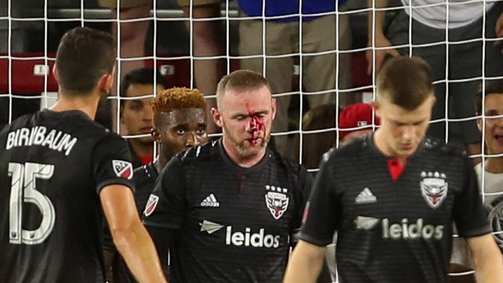 Wayne Rooney suffered a broken nose. GOAL